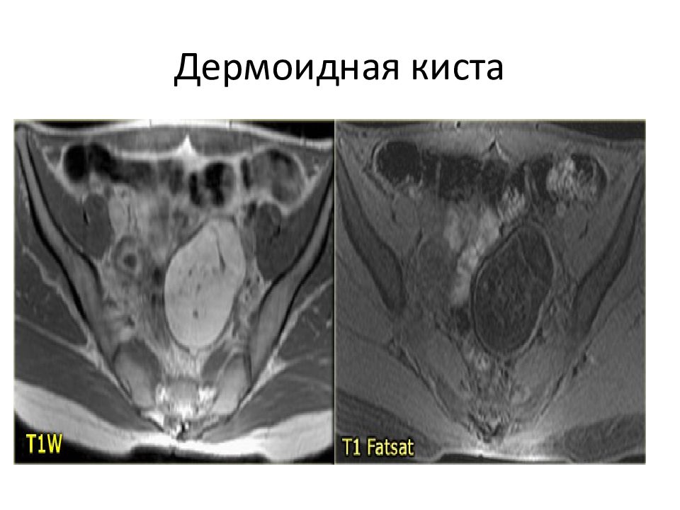 Кисты малого таза мрт. Дермоидная киста малого таза мрт. Дермоидная яичника мрт. Тератодермоидная киста.