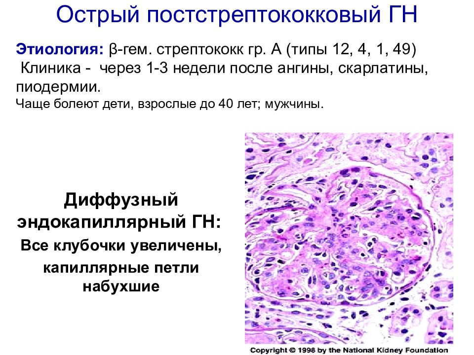 Острый постстрептококковый гломерулонефрит рекомендации. Постстрептококковый гломерулонефрит гистология. Острый стрептококковый гломерулонефрит. Постстрептококковый гломерулонефрит механизм. Стрептококковый гломерулонефрит патогенез.