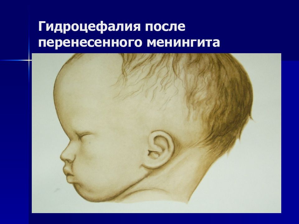 Причины гидроцефалии мозга. Врожденные патологии. Гидроцефалия.. Гидроцефальный синдром симптомы. Гипертензионно-гидроцефальный синдром у новорожденных. Олигофрения гидроцефалия.