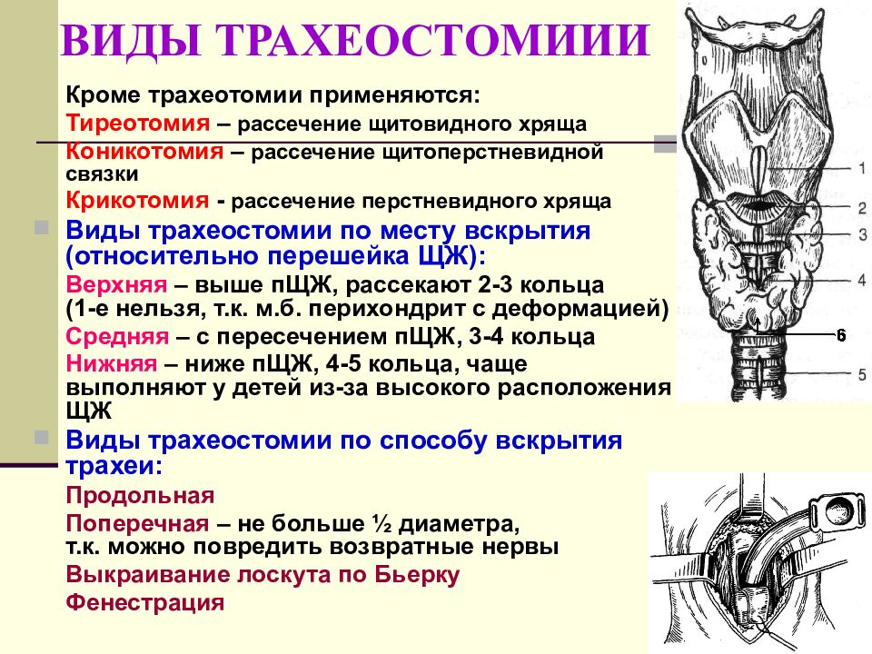 Трахеостомия. Верхняя трахеостомия Оперативная хирургия. Верхняя и нижняя трахеостомия топографическая анатомия. Трахеотомия трахеостомия коникотомия. Трахеостомия топографическая анатомия.