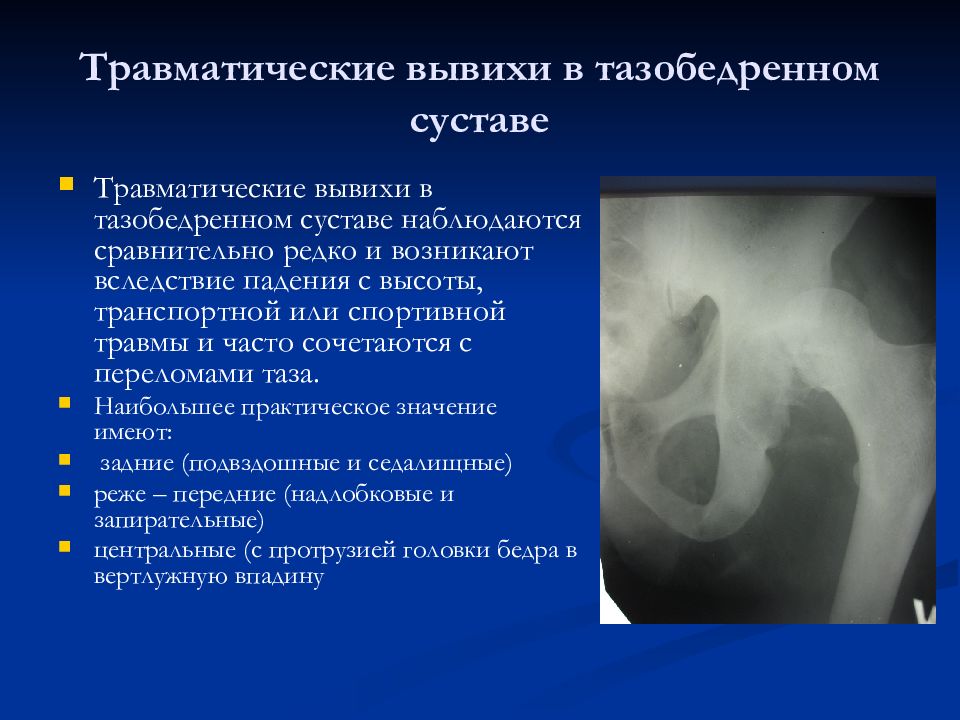 Травматические вывихи бедра презентация