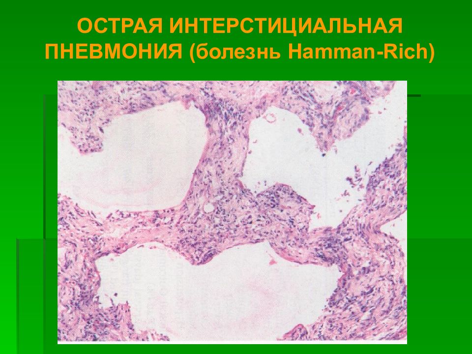 Патологическая анатомия это. Интерстициальная пневмония патологическая анатомия. Интерстициальная пневмония патанатомия. Пневмония патологическая анатомия. Хламидийная пневмония патологическая анатомия.