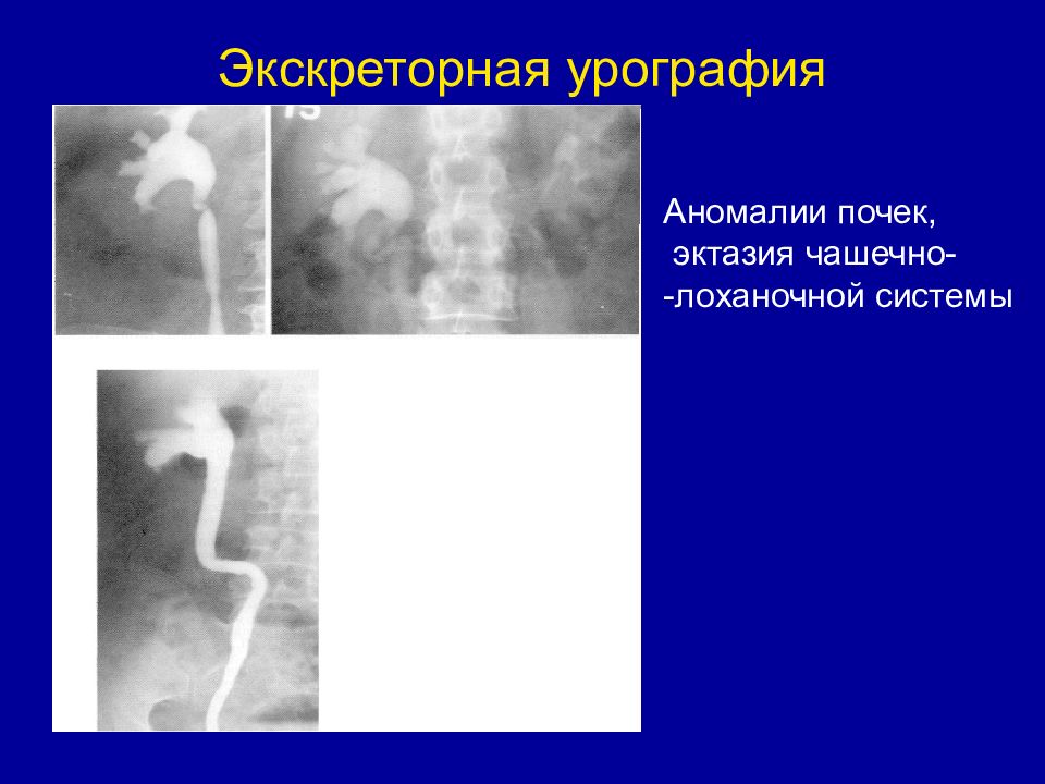 Расширение лоханочной системы почек. Экскреторная урография чашечно лоханочной системы. Аномалии чашечно лоханочной системы. Аномалия развития чашечно лоханочной системы. Экскреторная урография почек патология.