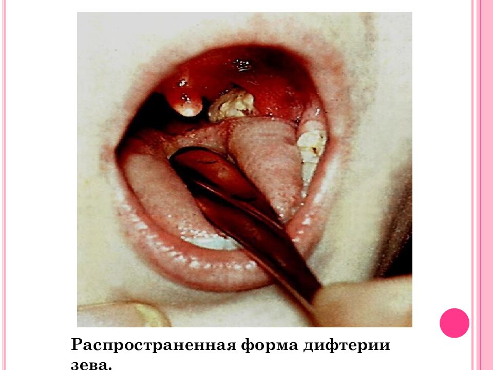 Токсическая форма дифтерии