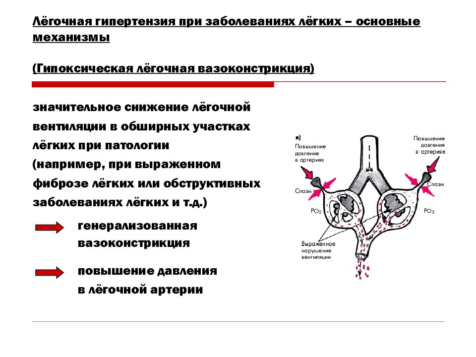 Легочная артериальная гипертензия презентация