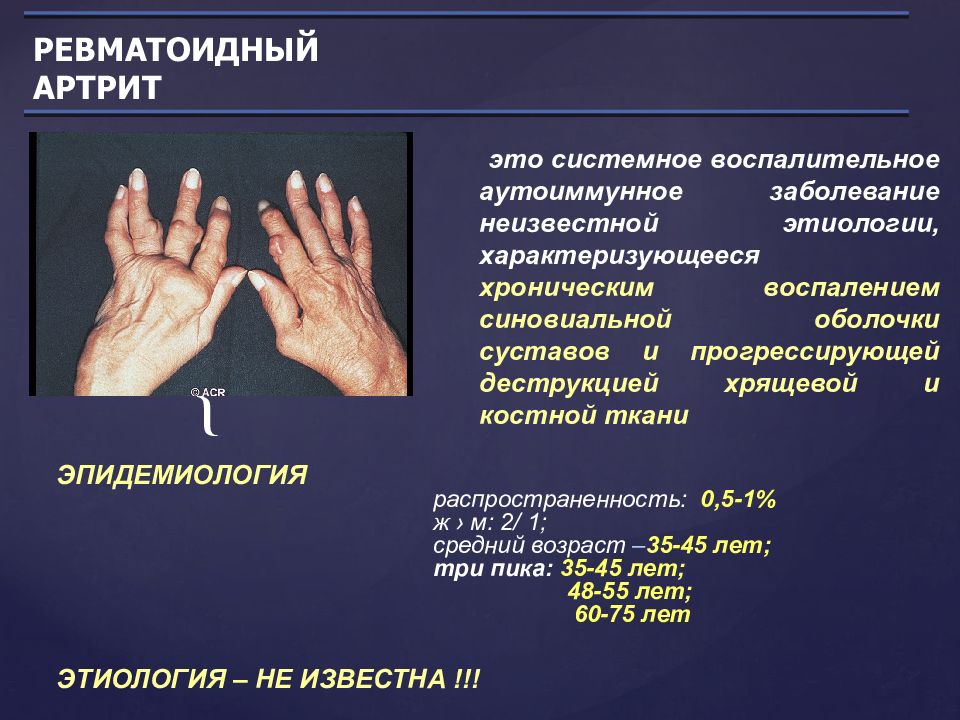 Ревматический полиартрит презентация