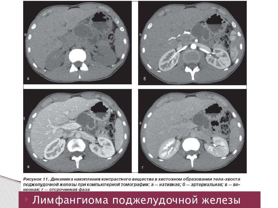 Можно ли кт с контрастом. Поджелудочная железа железа на кт. Гемангиолимфангиома поджелудочной железы кт. Аберрантная поджелудочная железа кт. Карцинома поджелудочной железы кт.
