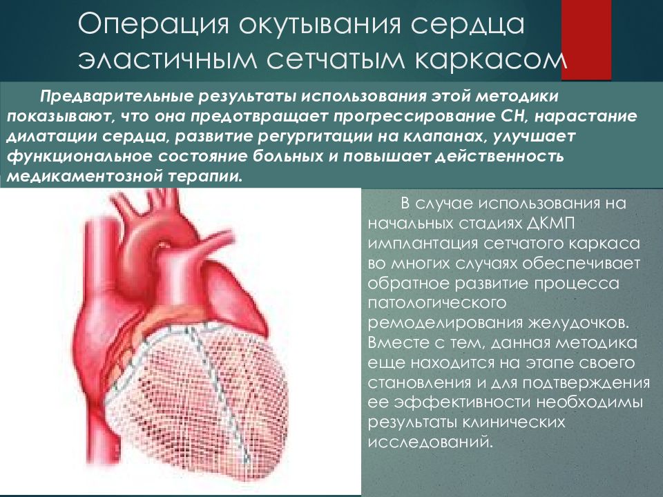 Сердечный применение. Окутывание сердца эластичным сетчатым каркасом. Операция окутывания сердца эластичным. Дилатационная миокардиопатия операция. Сетчатый каркас на сердце.