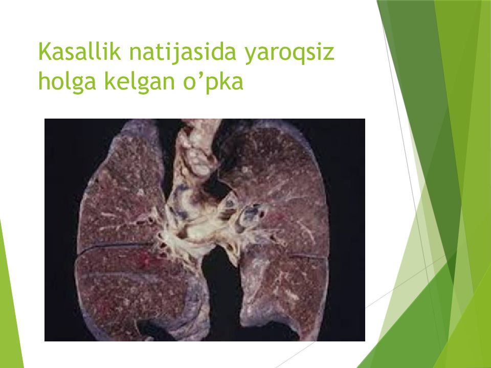 O'PKA OBSTRUKTIV YETISHMOVCHILIGI DIAGNOSTIKASI Kasallik natijasida yaroqsiz holga kelgan o’pka