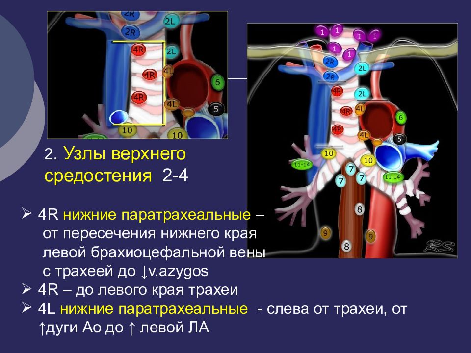 Лимфатические узлы средостения. Паратрахеальные лимфатические узлы на кт. Группы лимфатических узлов средостения на кт. Лимфоузлы средостения кт.