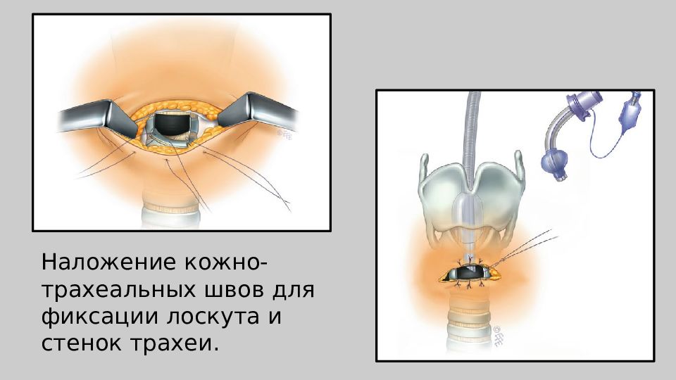 Торакальная хирургия презентация