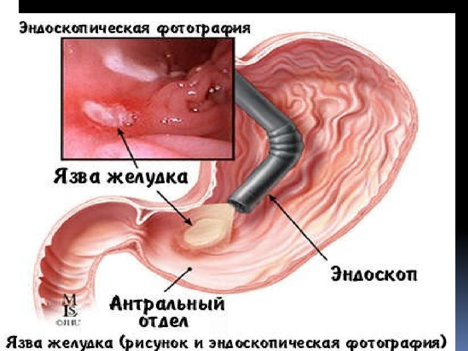 Язвенная болезнь желудка рисунок