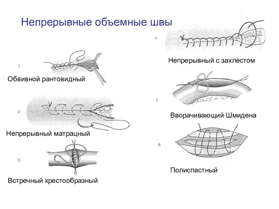 Виды хирургических швов презентация