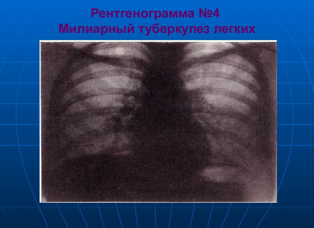 Милиарный туберкулез. Милиарный туберкулез рентген. Милиарный туберкулез описание рентгенограммы. Милиарный туберкулез легких рентген. Рентгенография милиарного туберкулеза.