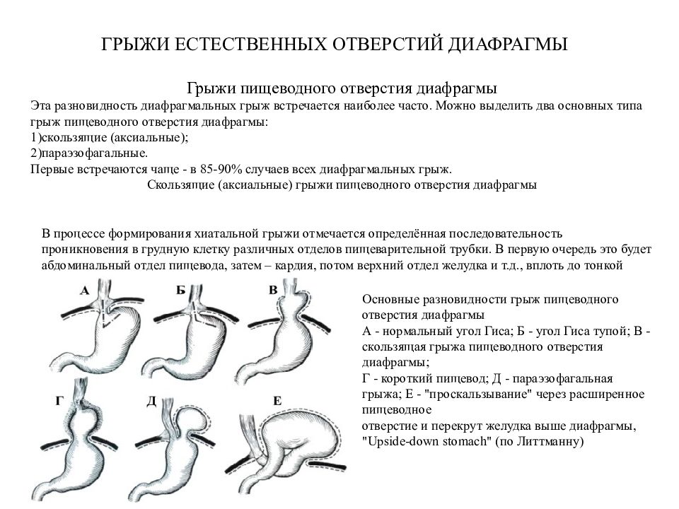 Диафрагмальные грыжи презентация хирургия