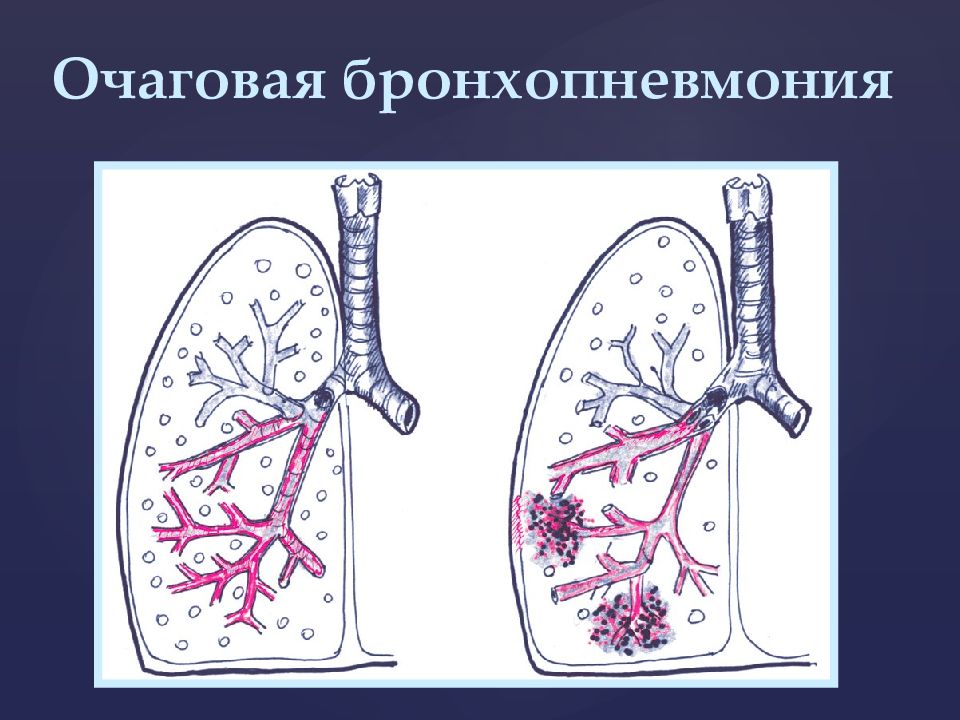 Пневмония очаговая презентация