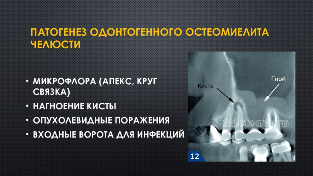 Одонтогенный остеомиелит челюсти презентация. Хронический периостит челюсти. Остеомиелит челюсти презентация. Периостит челюсти презентация.