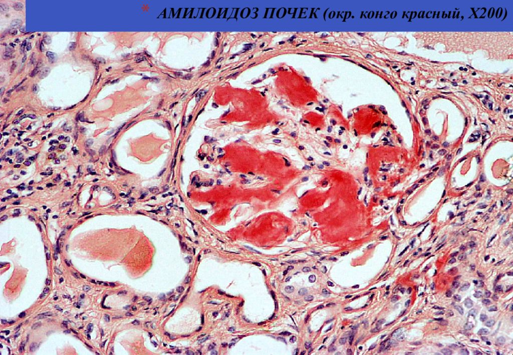 Амилоидоз почек презентация по терапии