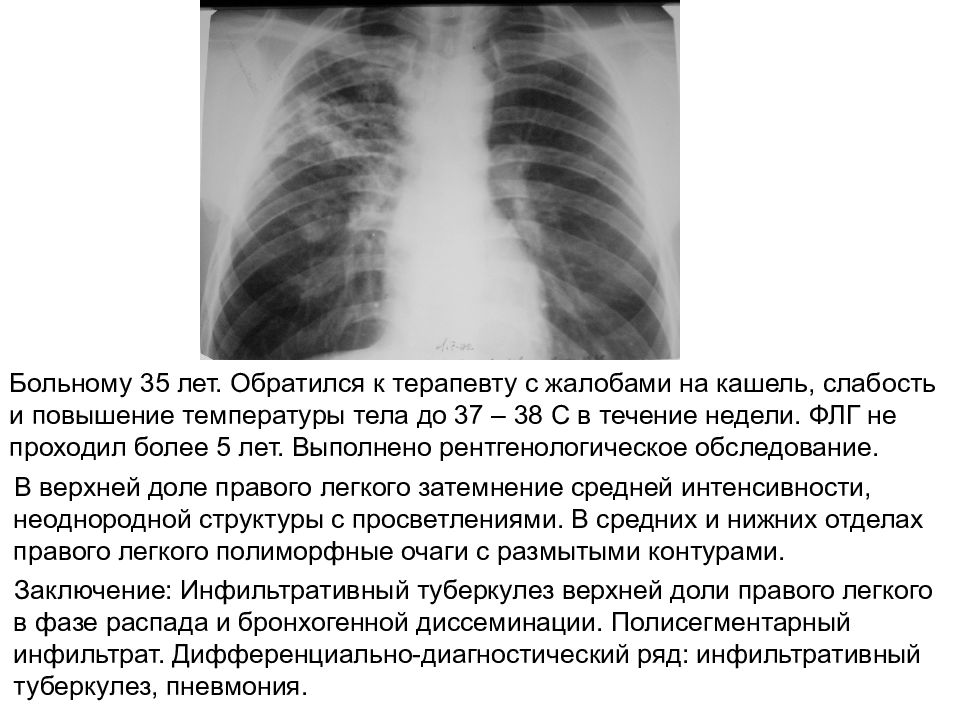 Нечеткие контуры легкого. Затемнение средней доли правого легкого. Затемнение средней интенсивности с нечеткими контурами. Затемнение легких средней интенсивности. Очаги с нечеткими контурами в легком.