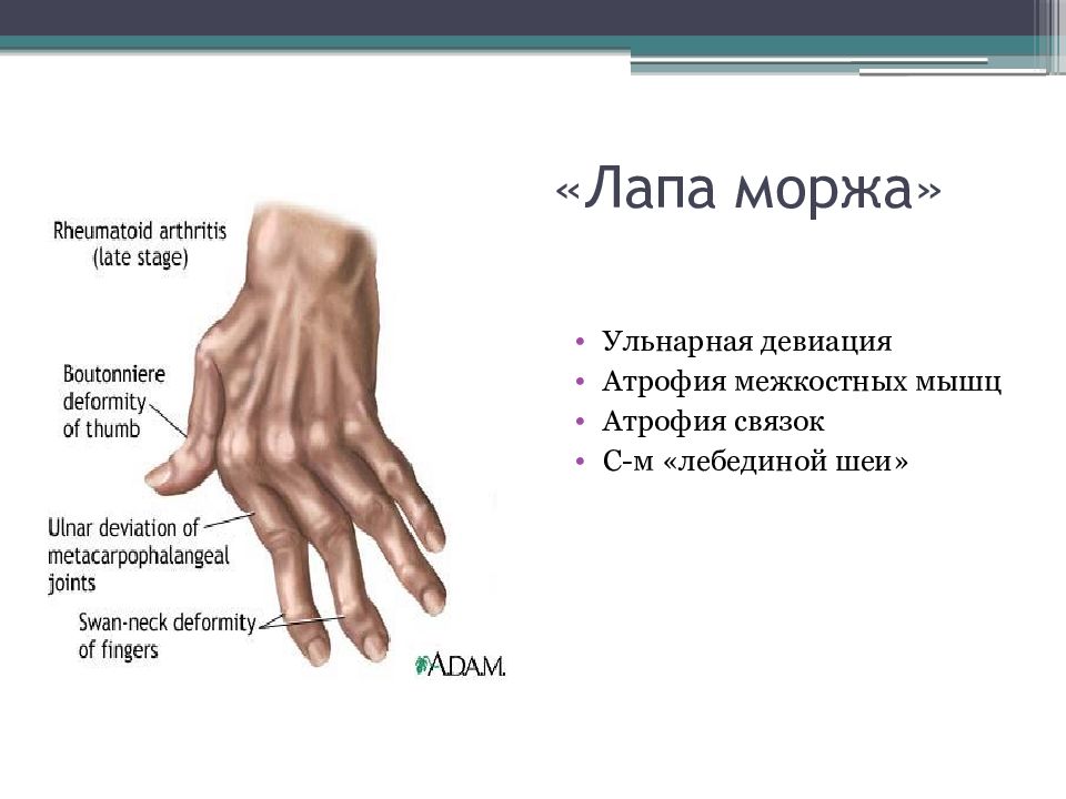 Синдром лапки. Ревматоидный артрит ульнарная девиация. Ульнарная девиация в суставах кистей. Ульнарная девиация пальцев кисти. Ревматоидный артрит кисть моржа.