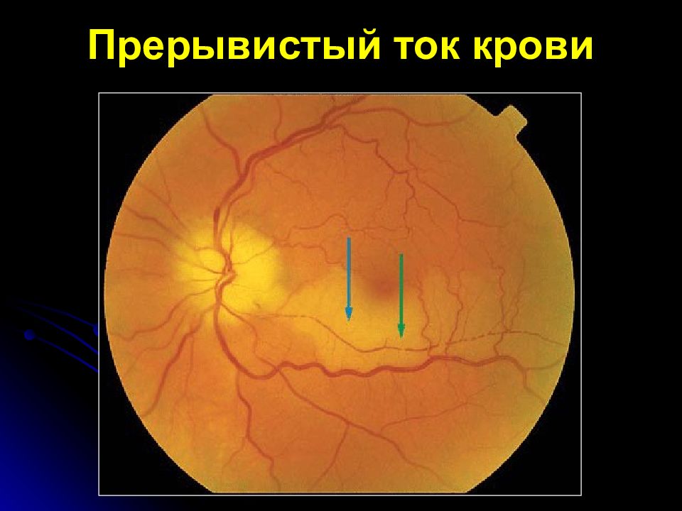 Возрастная макулярная дегенерация презентация