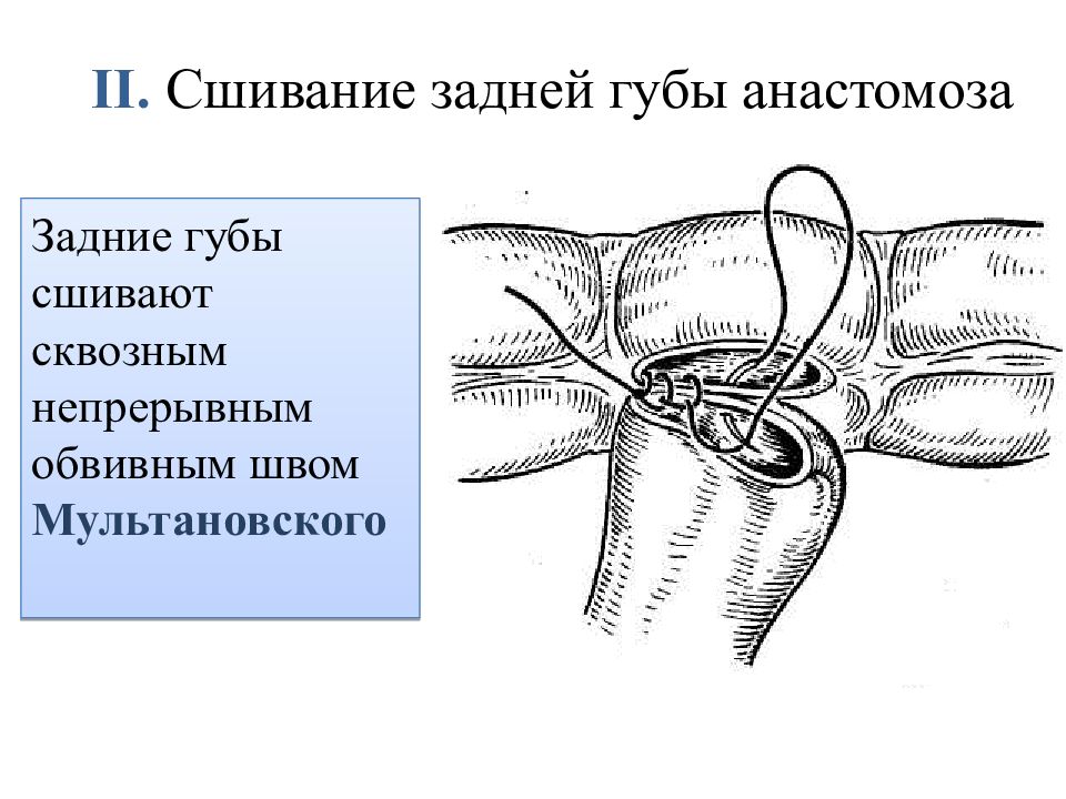 Кишечные анастомозы презентация