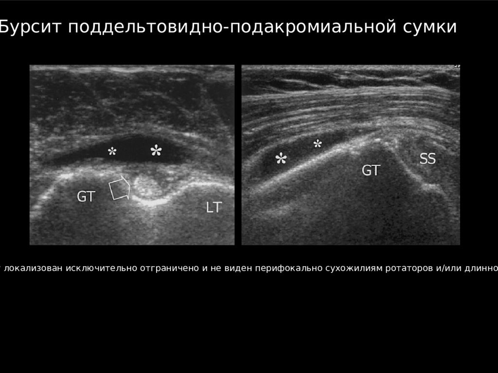 Узи плечевого. Поддельтовидный бурсит на УЗИ. Поддельтовидная сумка плечевого сустава на УЗИ. Поддельтовидный бурсит плечевого сустава на УЗИ. Поддельтовидный подакромиальный бурсит.