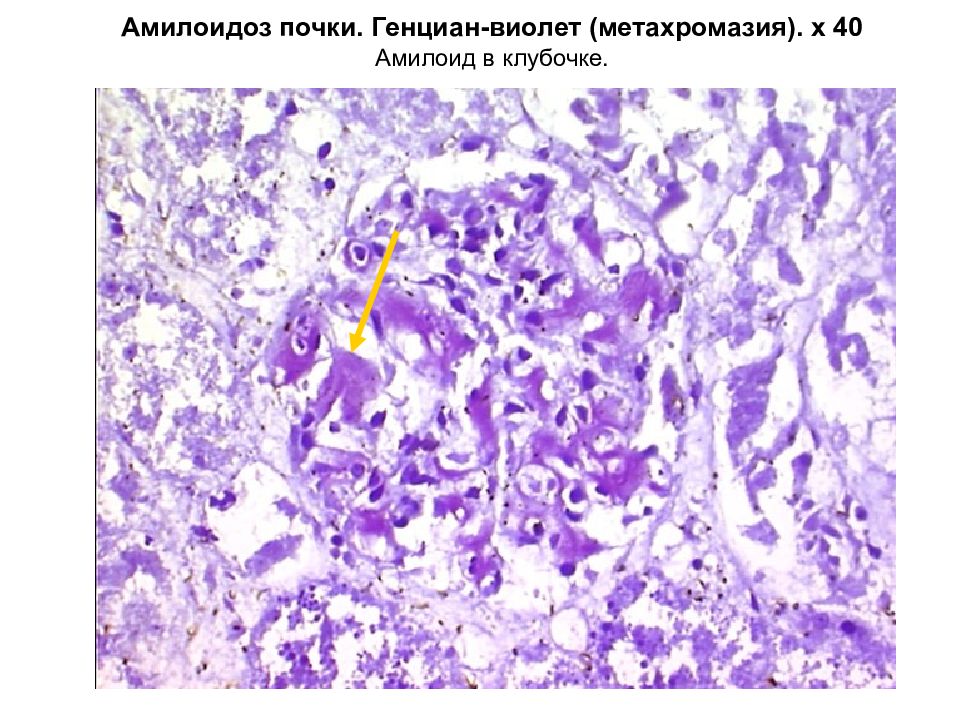 Амилоидоз почки рисунок