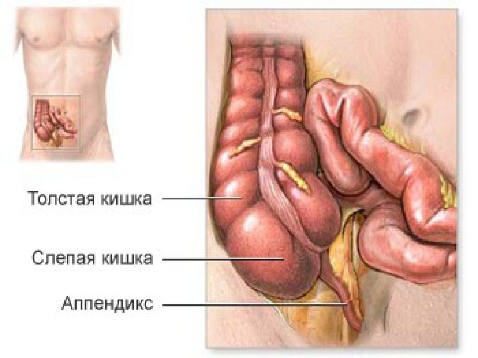 Где аппендицит картинка