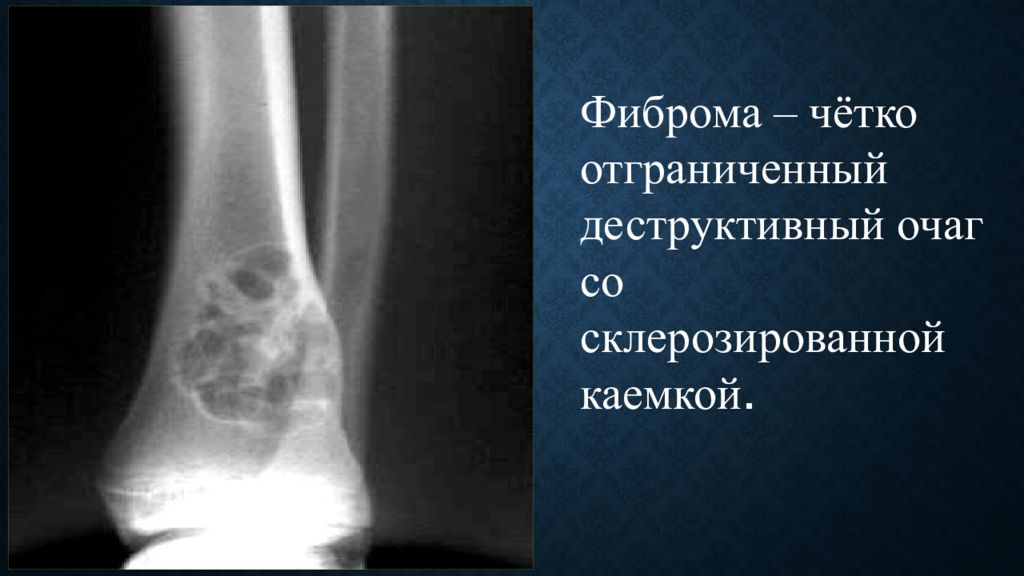 Фиброма кости. Склерозированный контур кости. Склерозированная костная ткань. Склерозированные участки кости. Литические очаги со склерозированными контурами.