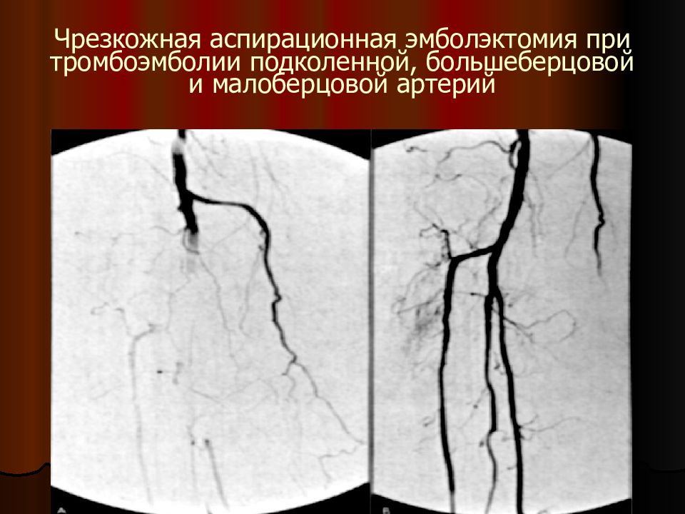 Интервенционная радиология презентация