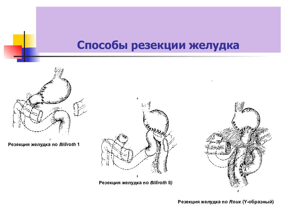 Резекция желудка. Резекция по Бальфуру схема. Основные этапы резекции желудка. Классификация видов резекции желудка. Резекция желудка схема.