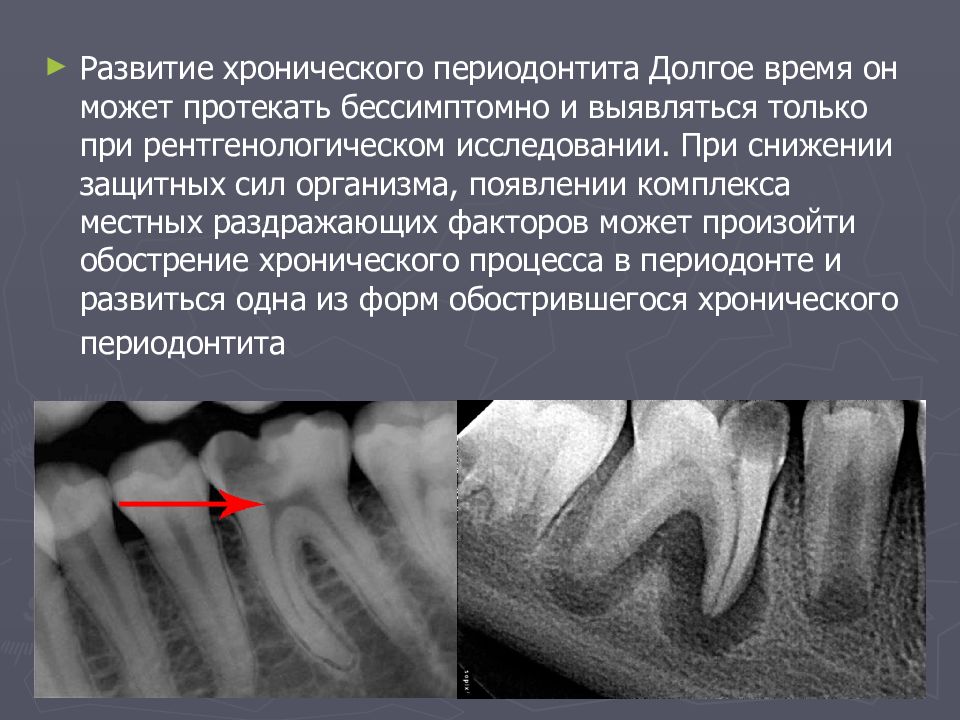 Острые формы пульпита. Обострение хронического периодонтита. Рентгенологические методы исследования периодонтита. Хронический фиброзный периодонтит мкб 10.