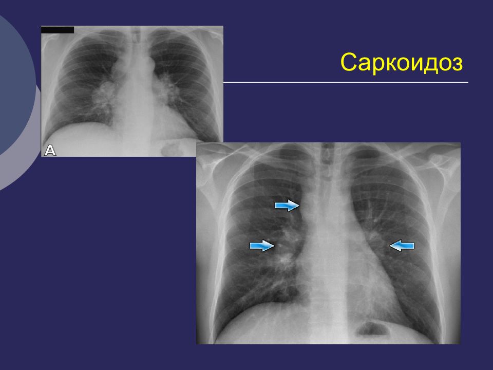 Саркоидоз легких что это. Саркоидоз 2 стадии рентген. Саркоидоз рентген грудной клетки.