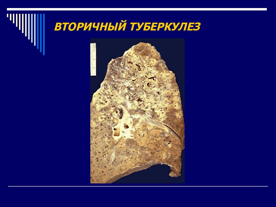 Вторичный туберкулез презентация