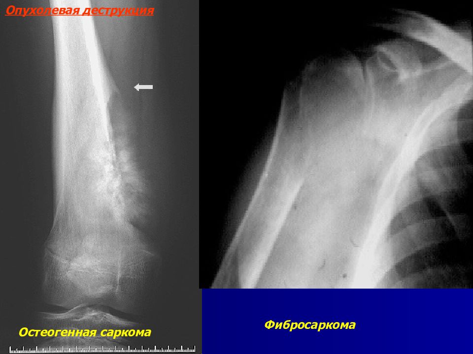 Фибросаркома. Рентгеносемиотика переломов костей. Рентгеносемиотика вколоченного вывиха. Фибросаркома степени g1 g2. Ренгеносемиотика флебоангиодисалазий.