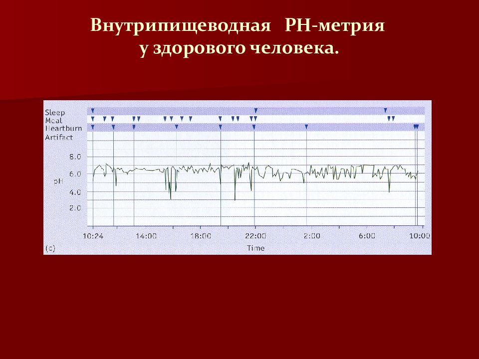 Рн метрия. 24 Часовая PH метрия пищевода. Внутрипищеводная суточная РН-метрия. Исследование суточная РН метрия. 24-Часовая внутрипищеводная PH-метрия.