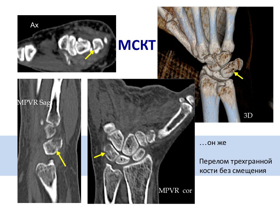 перелом трехгранной кости запястья. перелом крючковидной кости запястья рентген. ладьевидная кость перелом. вывих ладьевидной кости запястья. перелом ключивидной кости кисти.