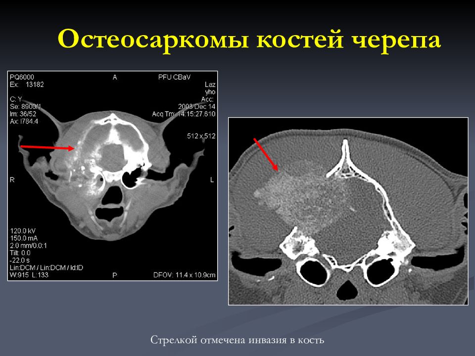 Кт костей. Хондросаркома костей черепа на кт. Остеосаркома костей черепа кт. Остеосаркома лобной кости кт.