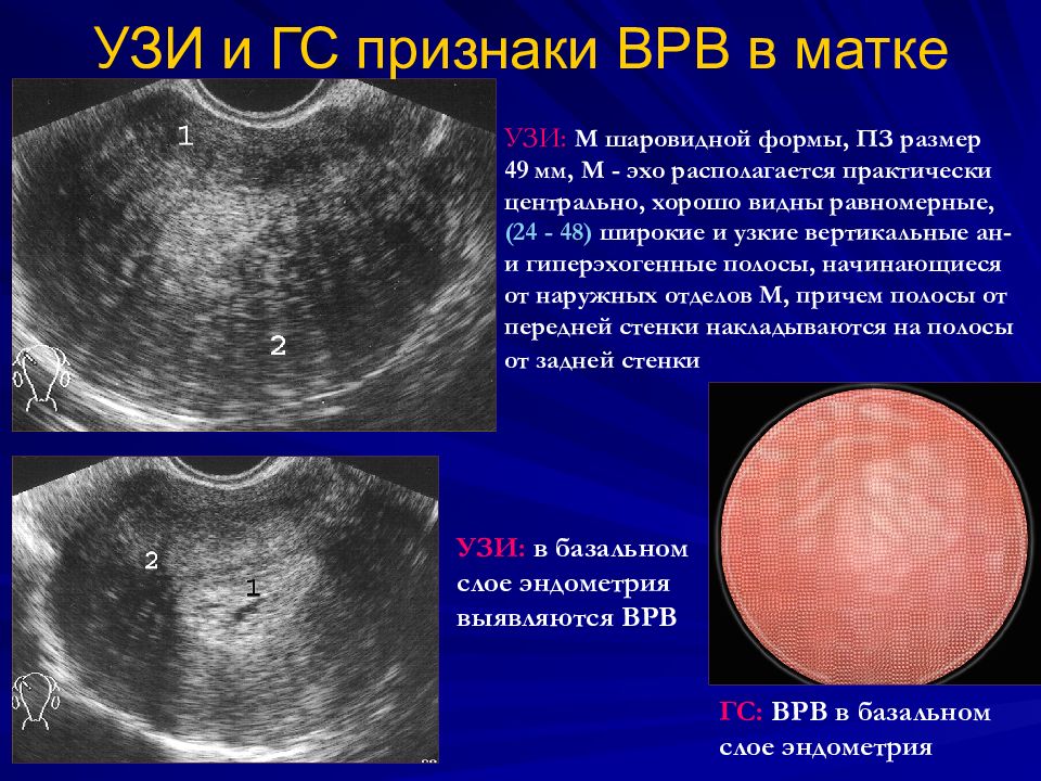 Размеры эндометрия матки. Шаровидная форма матки.