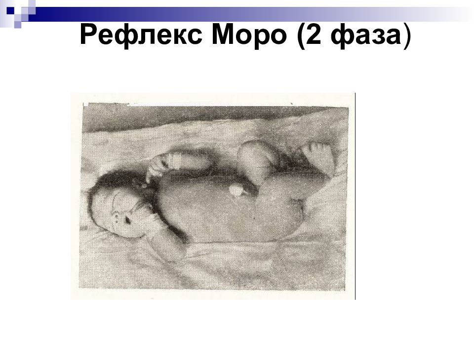 Рефлекс моро что это. Спонтанный рефлекс Моро у новорожденных что это. Рефлекс Моро 1 фаза. Синдром Моро.