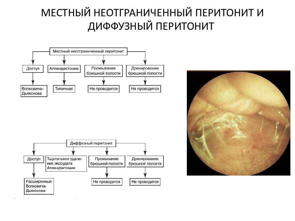 Акушерский перитонит картинки