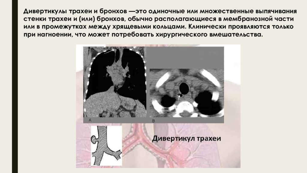 Пороки Развития Трахеи