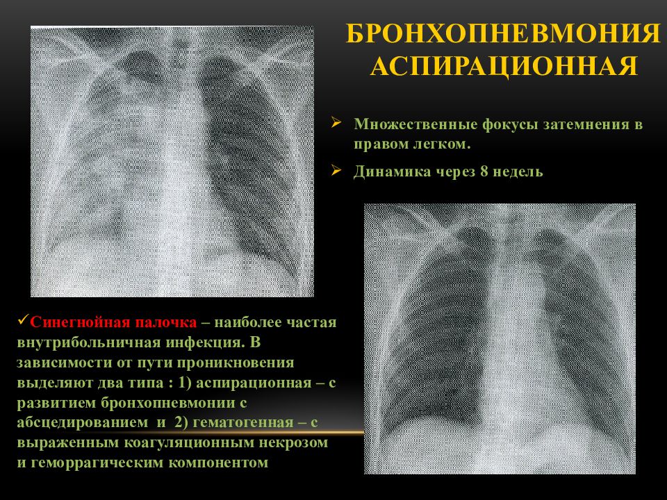 Бронхопневмония. Бронхопневмония у детей рентген. Бронхопневмония рентген описание. Бронхопневмония рентген заключение. Очаговая пневмония бронхопневмония.