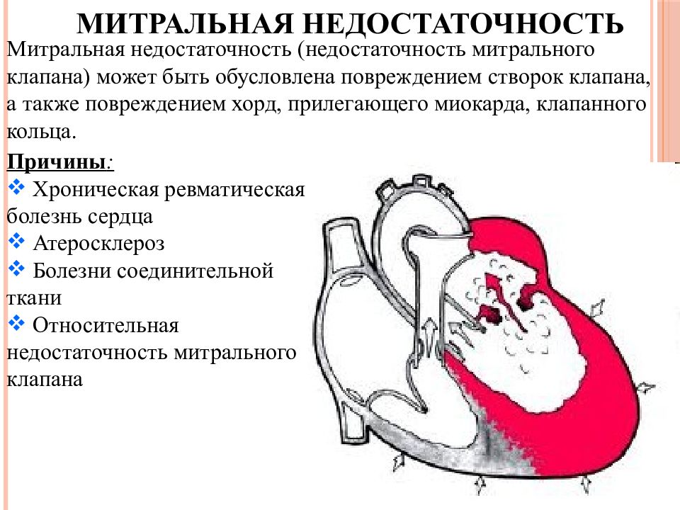 Схема гемодинамики при пороках сердца