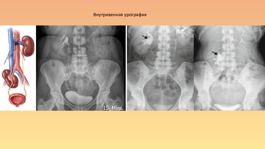 Контрастная урография почек