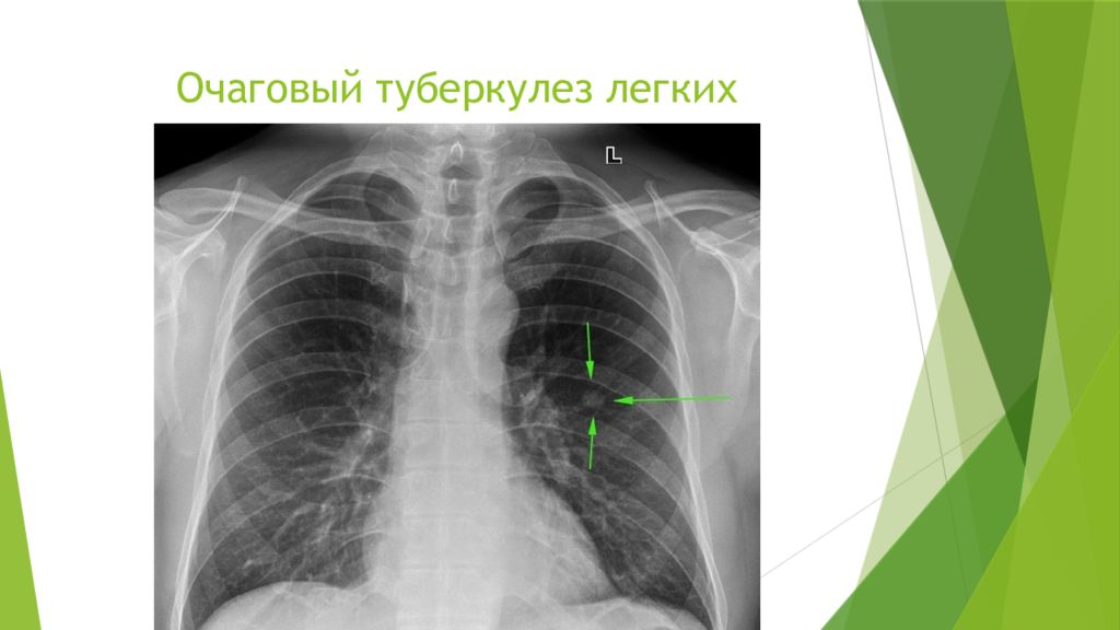 Рентген картина туберкулеза легких