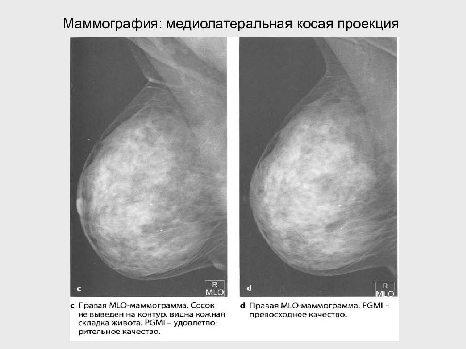 Что значит маммография. Косая проекция молочной железы. Маммография прямая и косая проекция. Косая проекция маммография. Маммография в косой проекции.