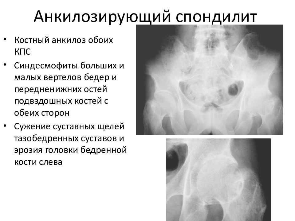 Анкилозирующий спондилит презентация