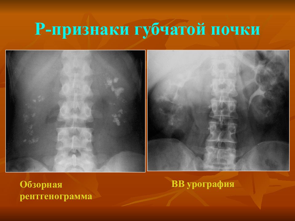 Р признаки. Губчатая почка экскреторная урография. Обзорная рентгенография почек презентация. Губчатая почка рентген.